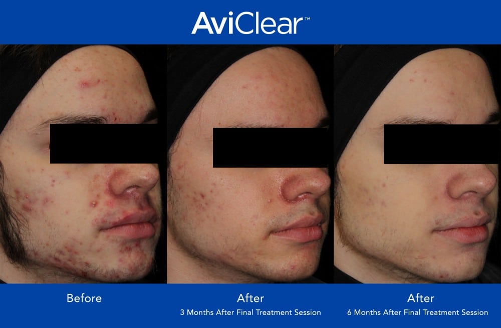 AviClear Before and After