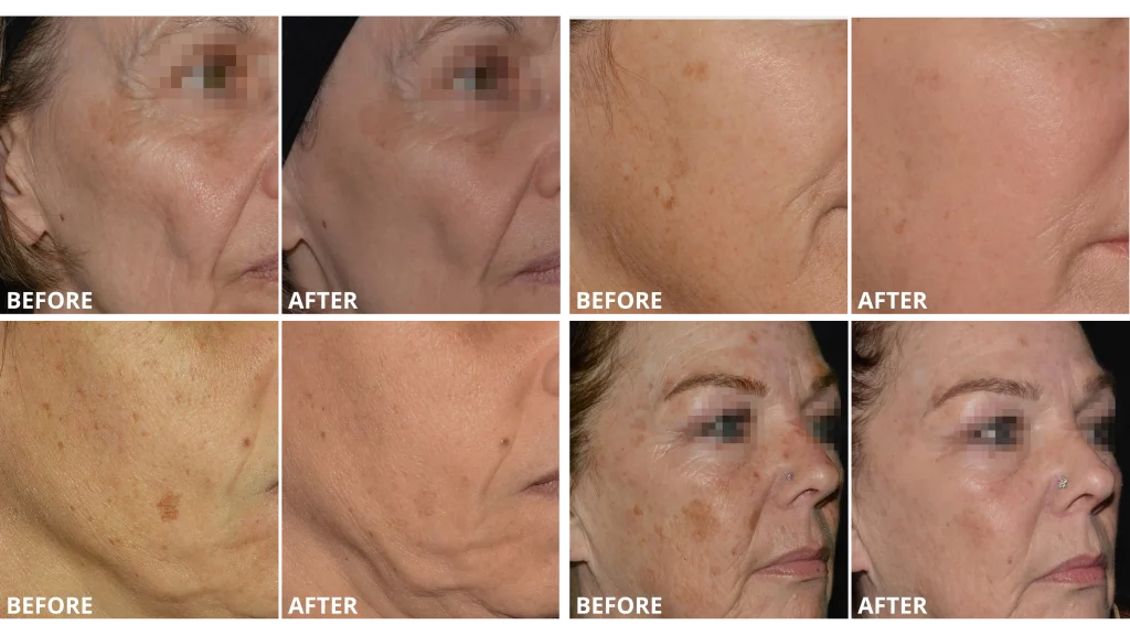 LaseMD Before and Afters