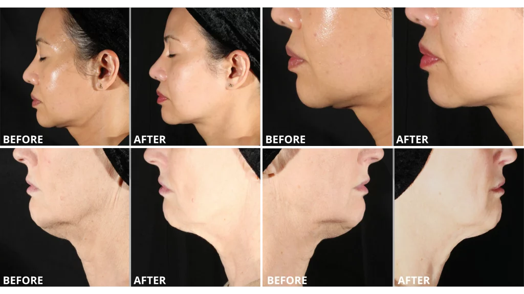 XERF Before and Afters